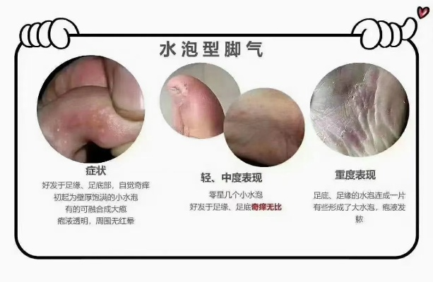脚上怎么分辨是湿疹还是脚气,一份清晰实用的鉴别指南 脚上怎么分辨是湿疹还是脚气,一份清晰实用的鉴别指南
